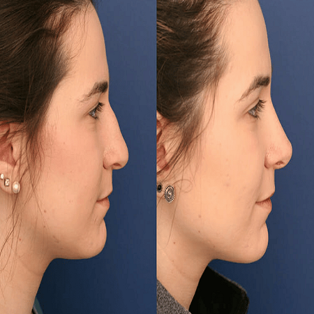 Rhinoplasty abu dhabi